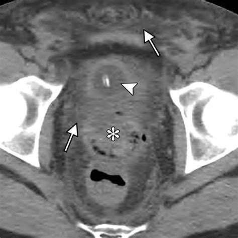 Imaging Findings In Transgender Patients After Gender Affirming Surgery