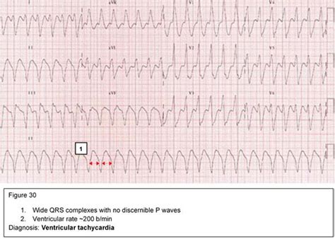 arrhythmias