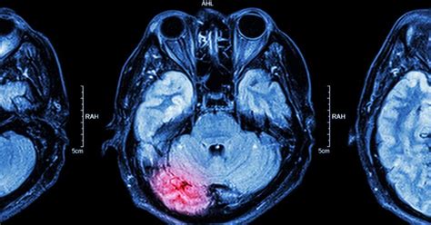 6 Things to Know About Brain Injuries - Regional Neurological Associates