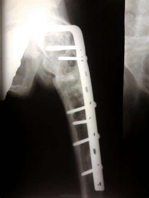 Болезнь Реклингхаузена | Портал радиологов