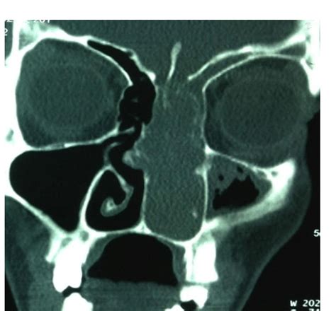 Contrast enhancing CT scan of Nose and PNS (coronal cut) showing ...