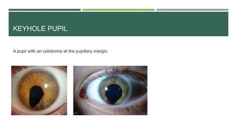 Abnormal Pupil Reactions Mehedi Hasan Ppt