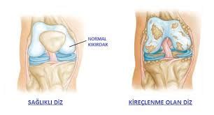 Kireçlenme Tedavisi Osteoartrit Fizyorem