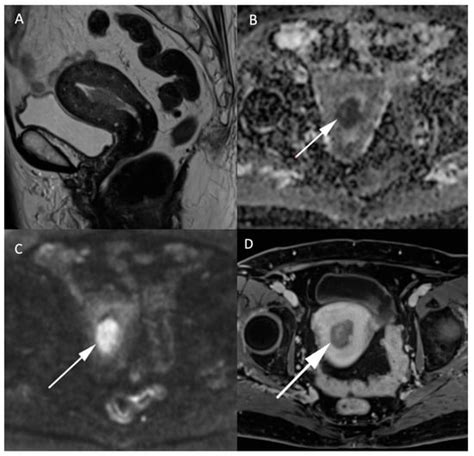 Jcm Free Full Text Diffusion Weighted Mri In The Genitourinary System