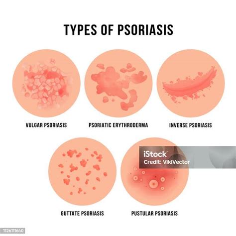 Psoriasis Skin Disease Types Of Derma Problem Stock Illustration