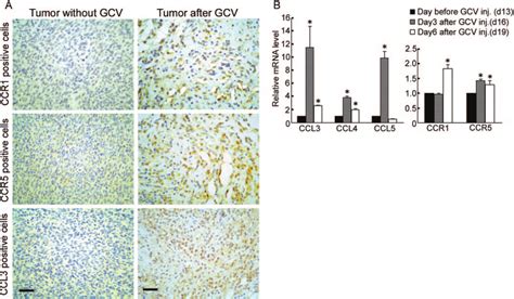 Accumulation Of Tumor Infiltrating Ccr1 Ccr5 Or Ccl3 Posi Tive