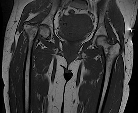 Bilateral Atraumatic Femoral Neck Fractures Resulting From Transient