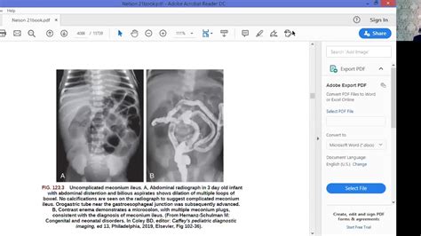 AN INFANT WITH DELAYED PASSAGE OF MECONIUM MECONIUM ILEUS 2 YouTube