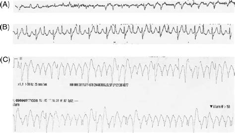 Polymorphic Vs Monomorphic Ventricular Tachycardia