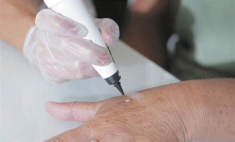 Cryopen™ Cryotherapy Mole Wart Skin Tag Removal