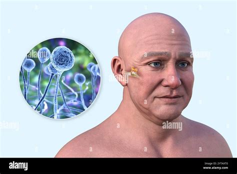 Computer Illustration Of A Man With Transparent Skin Showing Fungal