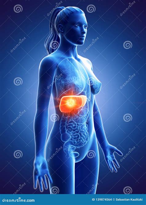 A Womans Liver Cancer Stock Illustration Illustration Of Hilum 139874564