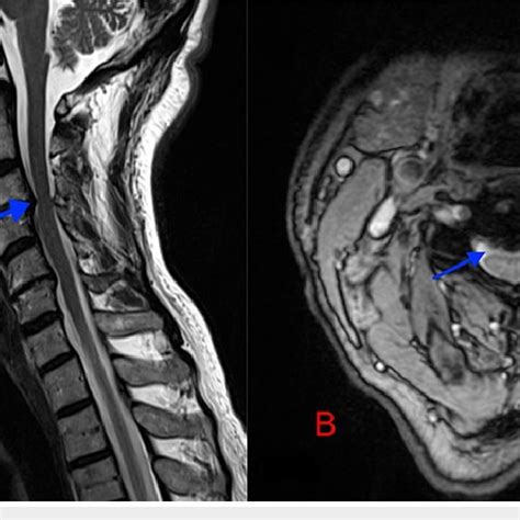 A Preoperative MRI T2 Sagittal And B T2 Axial Sequences Blue