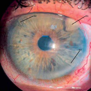 A Photograph Of The Anterior Segment Of The Left Eye After The Second