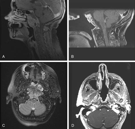 Surgical Management Of Lesions Of The Clivus Clinical Tree