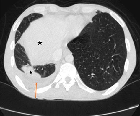 Pleural Effusion On Ct