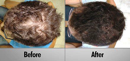 Professional Laser Hair Therapy -Clinically proven 90% Effective