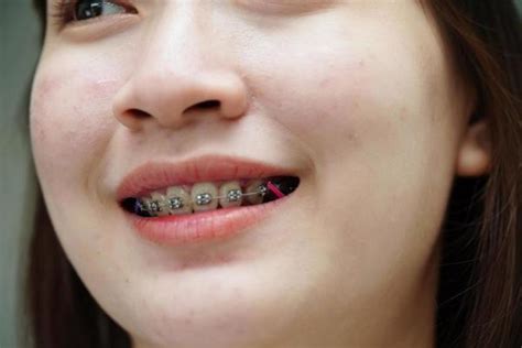 Invisible Braces Stock Photos, Images and Backgrounds for Free Download