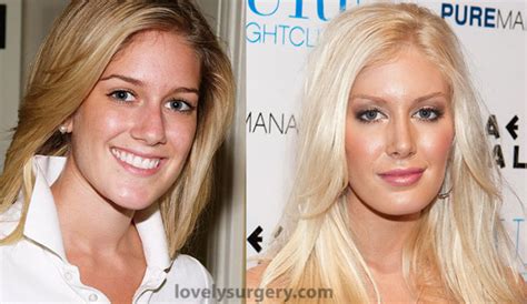 Total Transformation of Heidi Montag - Lovely Surgery | Celebrity ...