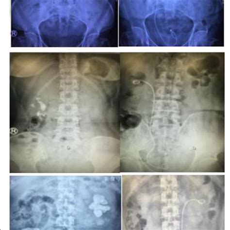 Pre and post-operative radiology for the 3 patients | Download ...