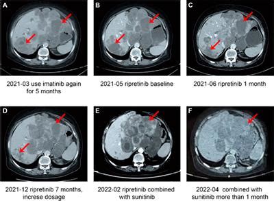 Frontiers Ripretinib In Combination With Tyrosine Kinase Inhibitor As