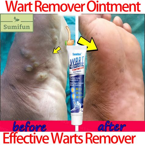 Sumifun Wart Remover Ointment Wart Treatment Cream Skin Tag Remover