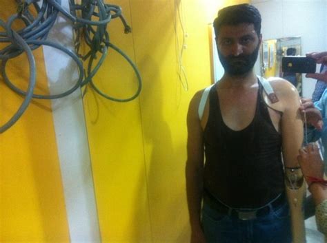 artificial full arm implant   price  delhi velocity