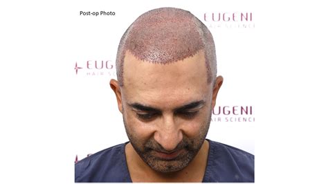 Norwood Scale 5a Baldness Hair Transplant And Treatment Uk