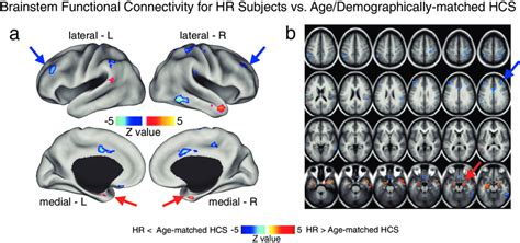 Brainstem Region Functional Connectivity For High Risk Subjects Hr Vs Download Scientific