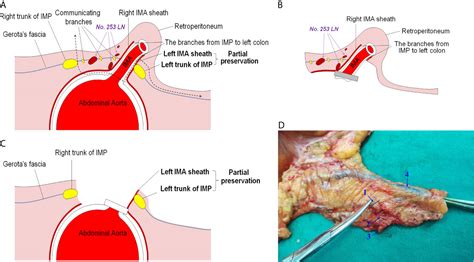 Frontiers An Intrasheath Separation Technique For Nerve Sparing High