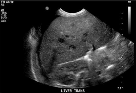 The Liver Ultrasound Image Showed Multiple Hypoechoic L Open I