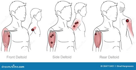 Myofascial Trigger Points Vector Illustration Cartoondealer