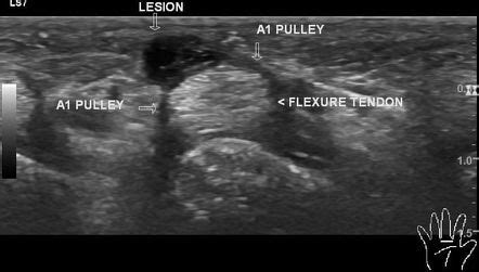 Ganglion Cyst Wrist Ultrasound