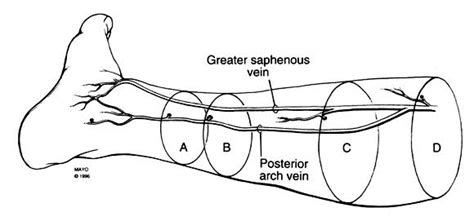 Surgical Anatomy For Endoscopic Subfascial Division Of Perforating Veins Journal Of Vascular