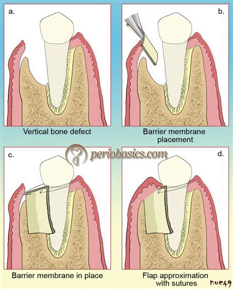 Guided Tissue Regeneration Periobasics