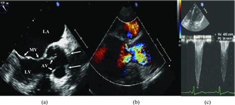 Discrete Subaortic Stenosis Thoracic Key