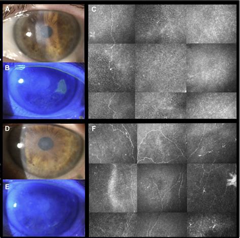 In Vivo Evaluation Of Corneal Nerves And Epithelial Healing After Treatment With Recombinant