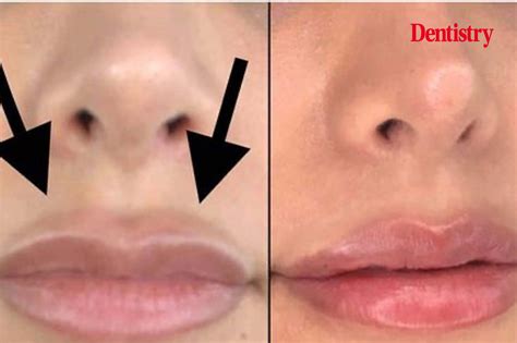 Facial Aesthetics 101 The Growing Trend Of Dissolving Filler Dentistry