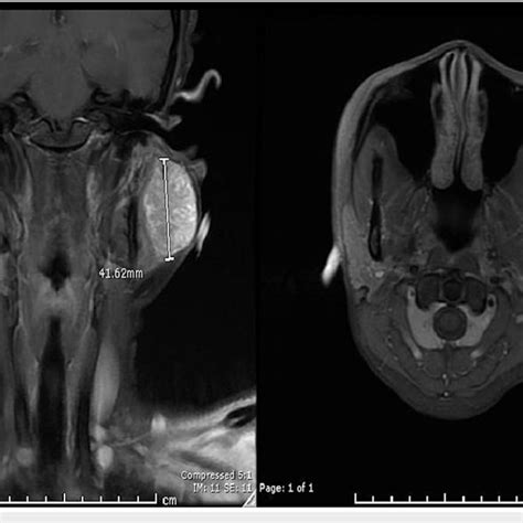 Mri Orbitfaceneck Without Contrast Which Revealed An Indeterminate