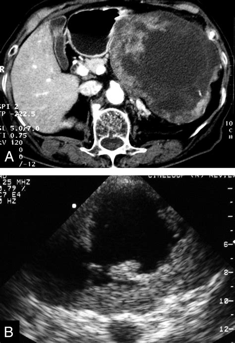 Exophytic Adenocarcinoma Of The Stomach Computed Tomography And Ultrasonography Features With