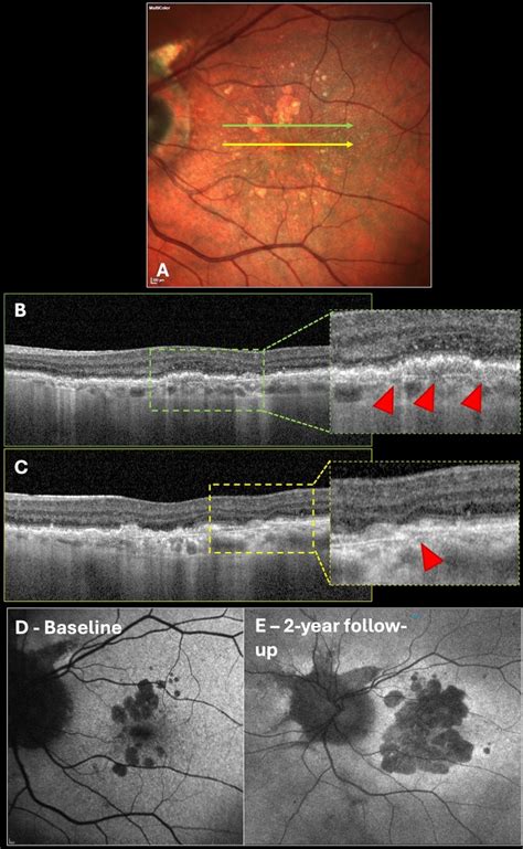 Geographic Atrophy Secondary To Subclinical Angioid Streaks In Age