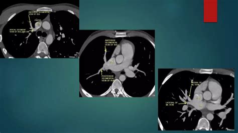 Anomalous Pulmonary Venous Drainage Total And Partial Ct Role Ppt
