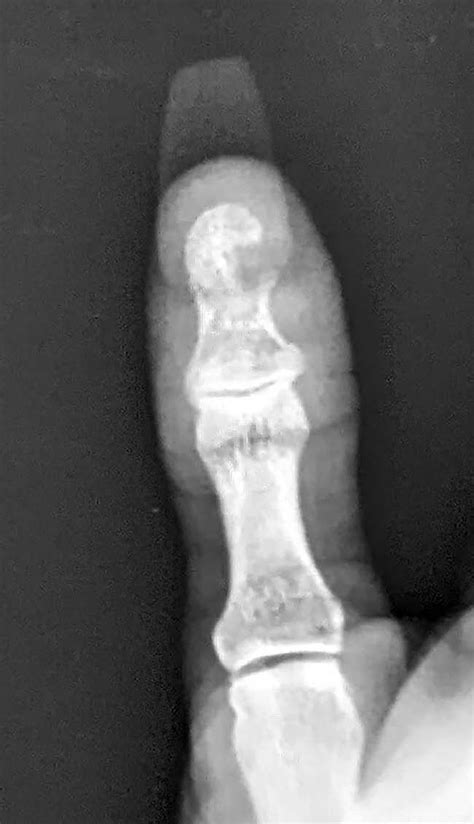 Preoperative X Ray Demonstrating Cystic Destruction Of The Distal