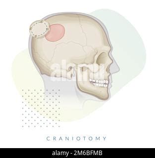 craniotomy surgery bone flap removal stock illustration  eps