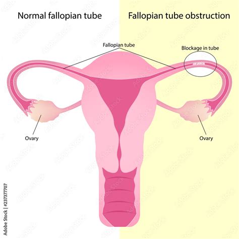 comparison  normal fallopian tube  fallopian tube obstruction
