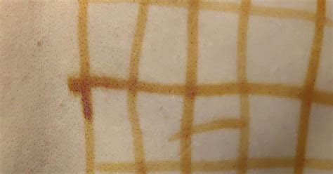 Йодная сетка: как, когда и для чего. 23 февраля 2023 г. Кубанские новости