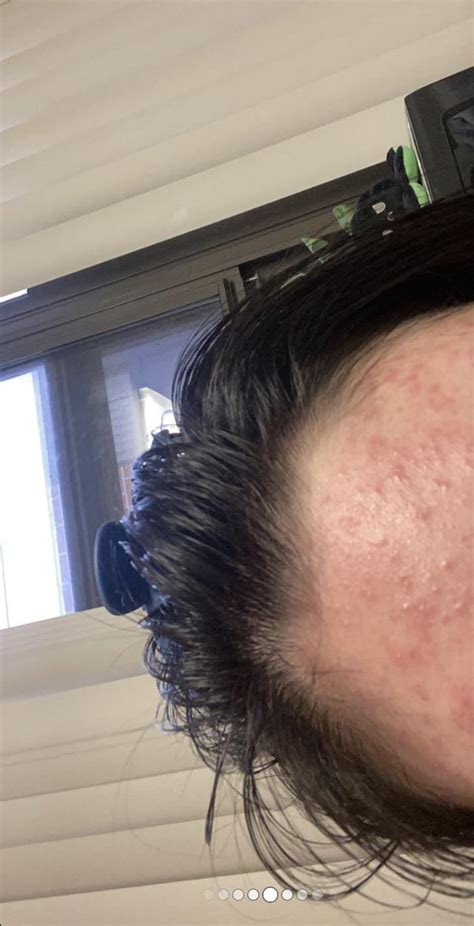 Is This Fungal Acne Or Part Of A Heat Rash It Began After I Worked An 8 Hour Shift On A Super