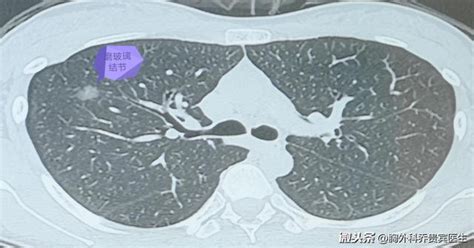 2個年輕女孩體檢發現惡變風險的磨玻璃結節，幸好及時手術處理了 每日頭條