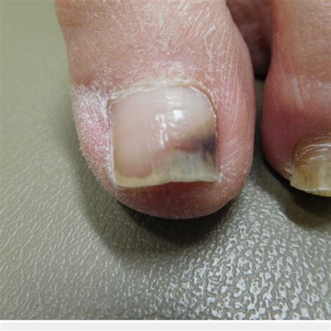 Pdf Non Melanoma Associated Dyschromia Of The Proximal Nail Fold