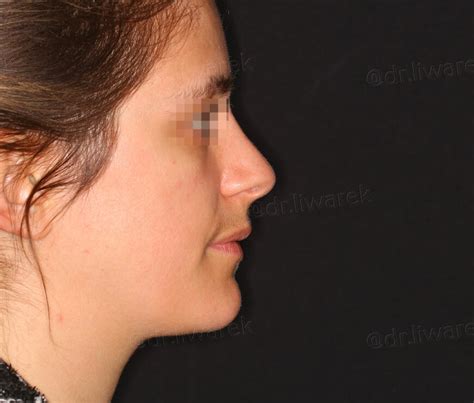 Les Photos Avant Apr S De Rhinoplastie Conservatrice Dr St Phane Liwarek